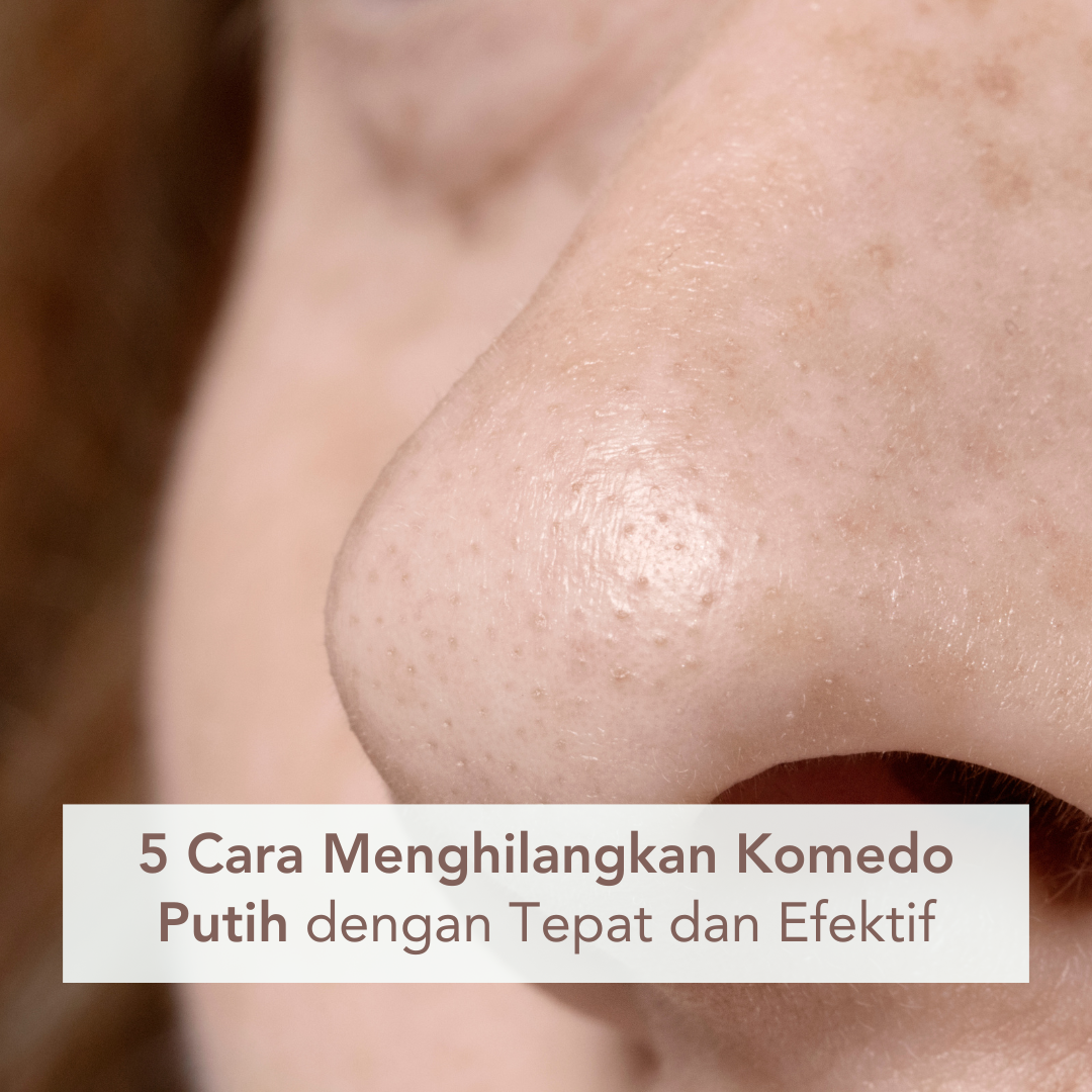 Hidung yang memiliki banyak komedo putih Hidung yang memiliki banyak komedo putih