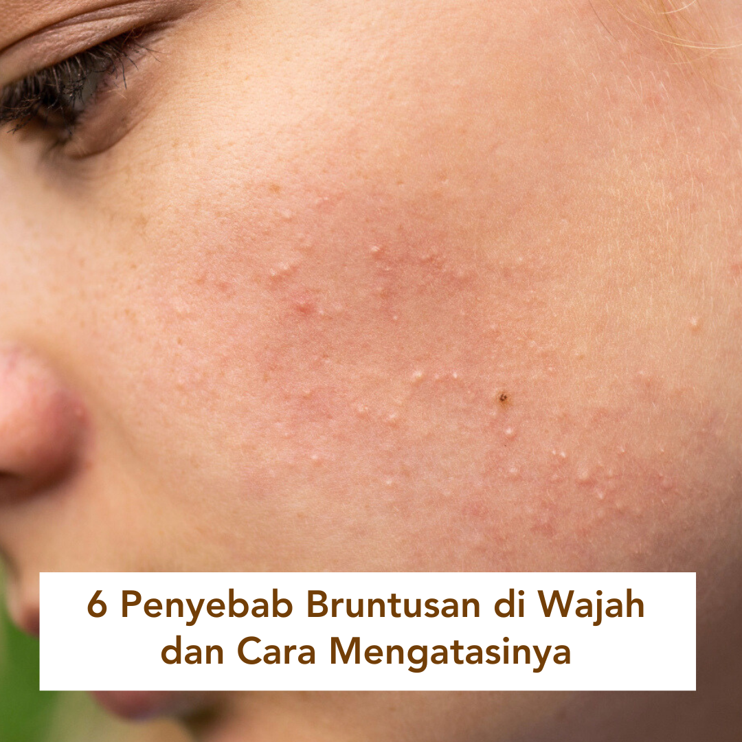 Perempuan yang pipinya terdapat bruntusan Perempuan yang pipinya terdapat bruntusan