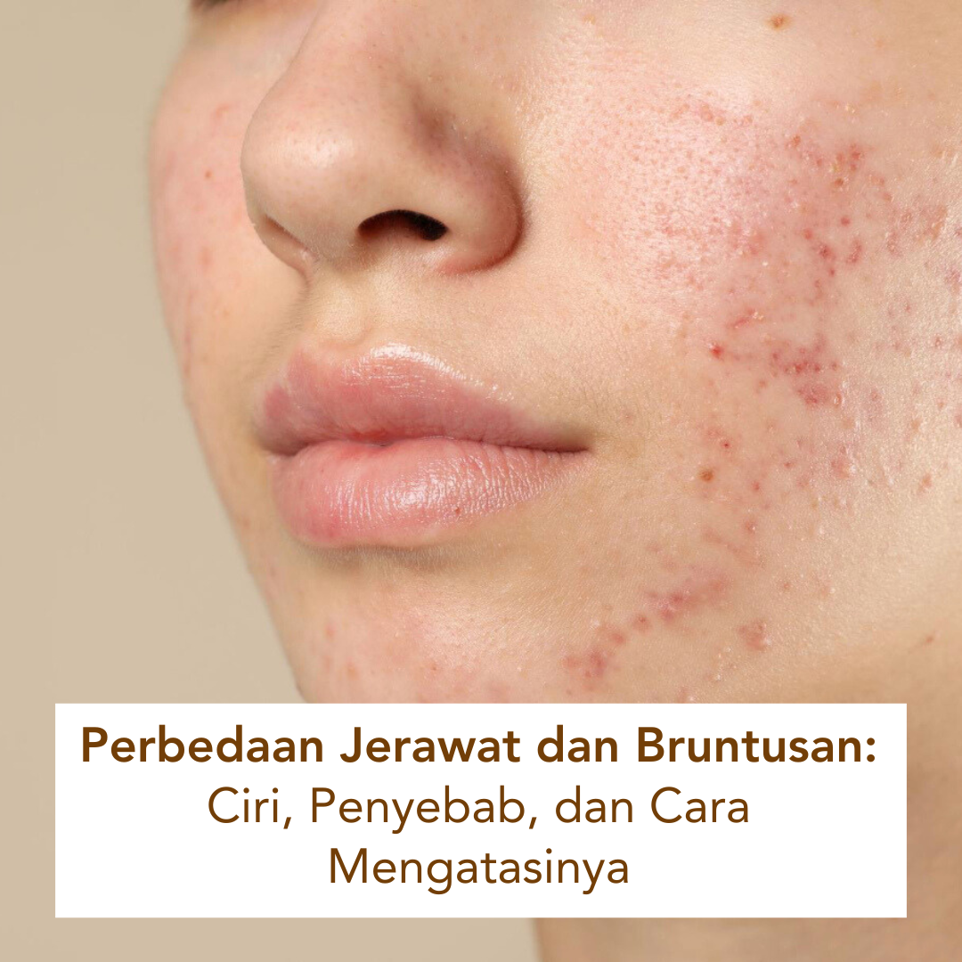 Wajah seorang perempuan yang jerawatan dan bruntusan Wajah seorang perempuan yang jerawatan dan bruntusan